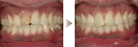 �E�H�[�L���O�u���[�`�O��